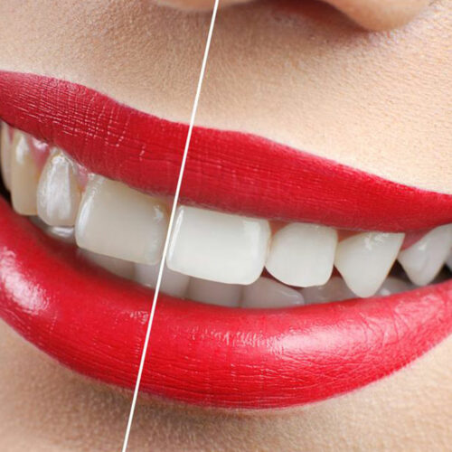 Yellow Teeth – How to avoid discoloration of teeth