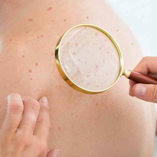 Atopic Dermatitis Eczema – Causes, Symptoms, and Treatments