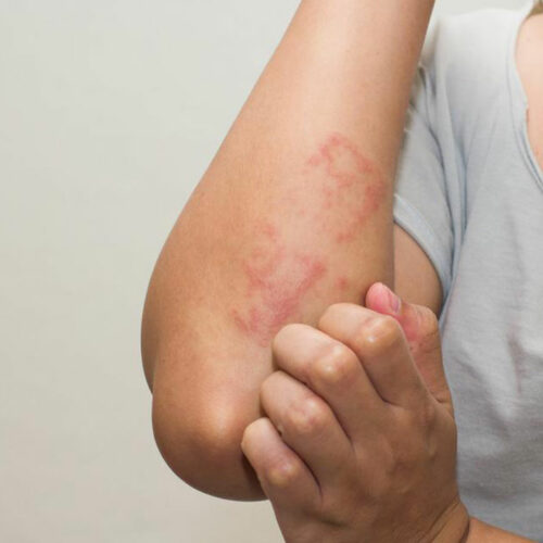 Lupus Skin Rash – Symptoms and Treatment